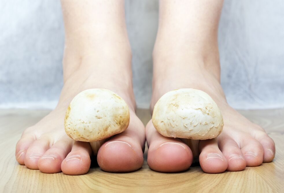 Ciuperca comună a unghiilor de la picioare