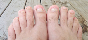Ciuperca unghiilor de la picioare