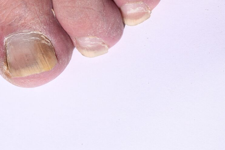 etapa inițială a micozei unghiilor de la picioare
