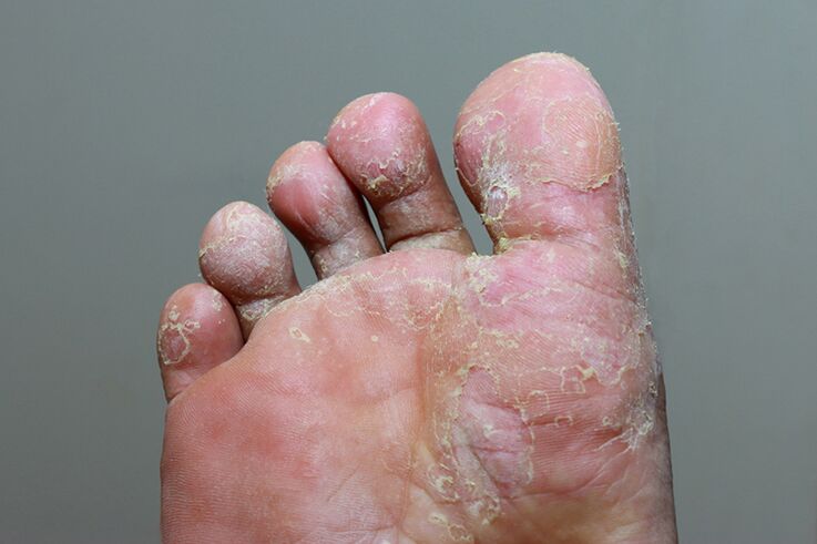 stadiul sever al micozei pielii degetelor de la picioare
