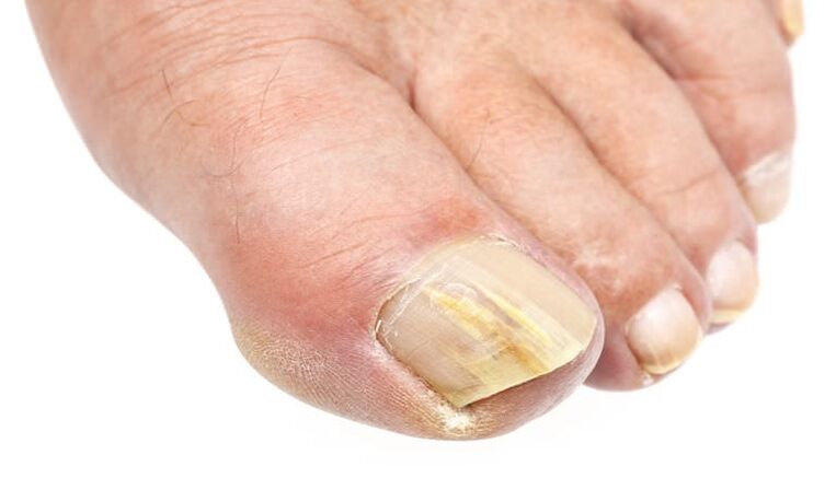 schimbarea externă a unghiei este un semn al infecției fungice