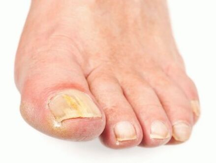 deteriorarea unghiilor cu ciuperca pe picioare