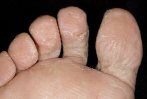 simptome de ciuperci pe pielea picioarelor