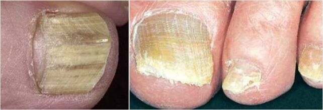 Forma avansată de ciupercă a unghiilor de la picioare