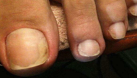 Semne ale stadiului inițial al ciupercii unghiilor de la picioare
