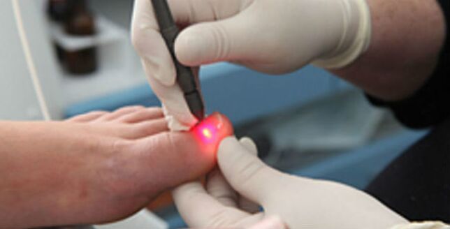 Terapia cu laser pentru ciuperca unghiilor de la picioare