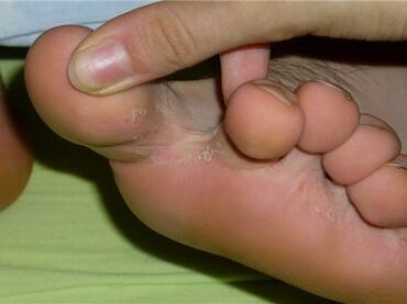 ciuperca între degetele de la picioare