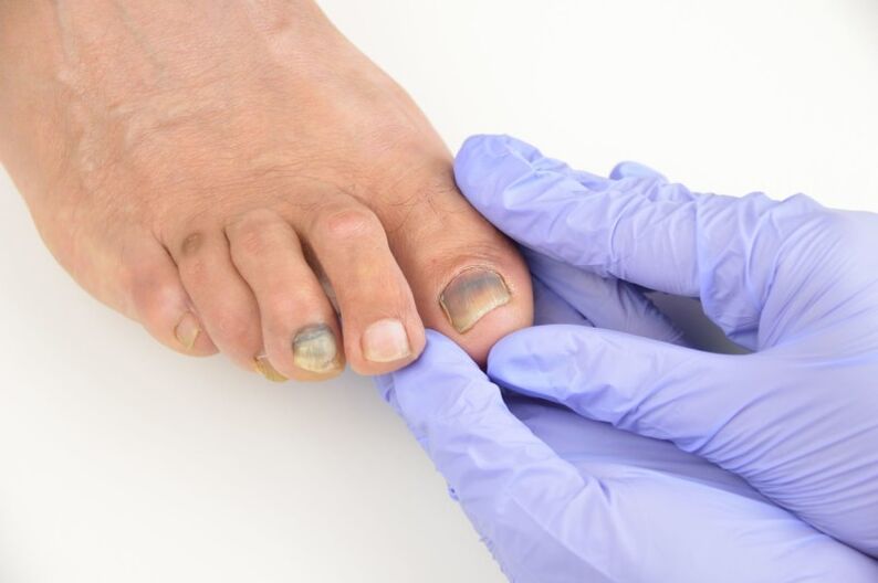 Examenul medical al unghiilor de la picioare afectate de o ciupercă